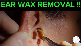 Ear Wax Removal  Function of Cerumen [upl. by Desiri]