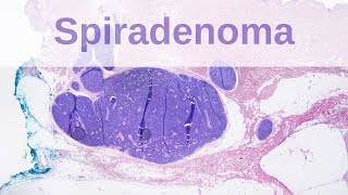 Eccrine Spiradenoma  Pathology mini tutorial [upl. by Nowad]