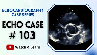 ECHO Case 103  Echocardiography for Beginners  Echocardiogram Interpretation [upl. by Nnylak]