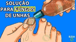 👠Está é a Melhor Solução Para Remover FUNGOS Nas UNHAS Receita Caseira [upl. by Frasch]