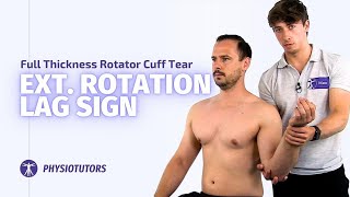 External Rotation Lag Sign  Full Thickness Rotator Cuff Tears [upl. by Ahcas]