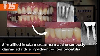 Simplified implant treatment at the seriously damaged ridge by advanced periodontitis 15th [upl. by Artemisa404]