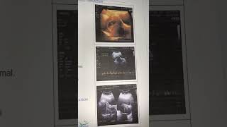 My pregnancy scan report  7th week scan ultrasound Scan pregnancy pregnancyscan [upl. by Weinberg239]