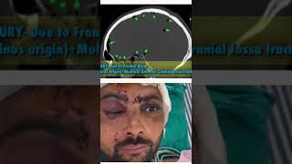 Anterior cranial fossa floor repair Cribriform plate fracture Best Neurosurgeon in Jaipur [upl. by Ennaj395]