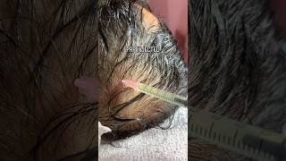 🩷 PRP HAIR TREATMENT alopecia aestheticclinic prp microneedling [upl. by Anaerdna]