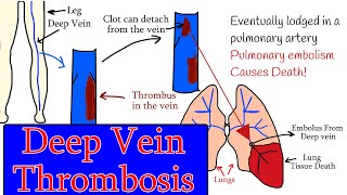 Deep vein Thrombosis DVT  Symptoms diagnosis and treatment Homan sign [upl. by Stutzman]