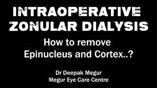 Intraoperative Zonular Dialysis How to remove Epinucleus and Cortex  Dr Deepak Megur [upl. by Ellesor]