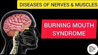 BURNING MOUTH SYNDROME [upl. by Ydnis]