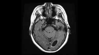 Periventricular leukomalacia Axial T2 FLAIR [upl. by Asirrac482]