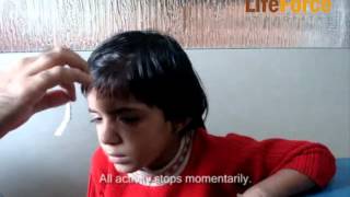 Video of Child with Petit Mal Epilepsy Attack Induced by Exertion Physical Effort [upl. by Nojad]