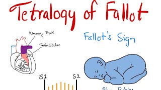 Tetralogy of Fallot Pathogenesis Signs and Management Everything you need to know [upl. by Tirrell399]