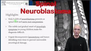 Spinal Neuroblastoma [upl. by Nahtannhoj424]