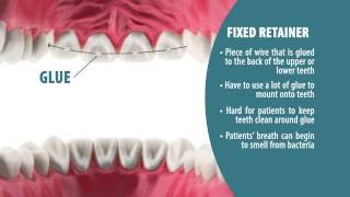 Types of Retainers  Retainer Wear Part 2 [upl. by Christoph]