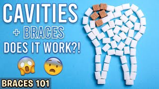 BRACES 101 CAVITIES amp Braces  Treatment Minute Talk [upl. by Viveca]