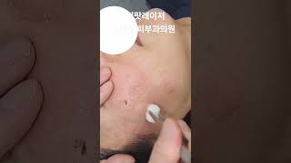 리팟 레이저 다발성 흑자 세종리팟 세종시리팟 reepot lentigo multiplelentigo 청주리팟 공주리팟 대전리팟 오창리팟 오송리팟 부여리팟 [upl. by Noslien]