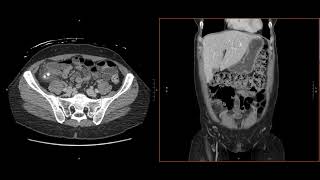 Abdominal Imaging Call Prep Cases Acute Uncomplicated Appendicitis CT Search Pattern [upl. by Krisha312]