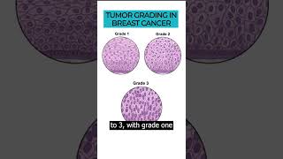 Unravel the importance of tumor grading in breast cancer treatment 🎗️🔬 [upl. by Jeuz]