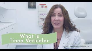 Tinea Versicolor How to Treat [upl. by Acnalb952]