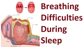 Methods to Improve Breathing Difficulties During Sleep by Prof John Mew [upl. by Suoicerpal]