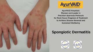 Significant Recovery from Spongiotic Dermatitis Eczema AyurVAID Hospital Domlur Bangalore [upl. by Fidole]