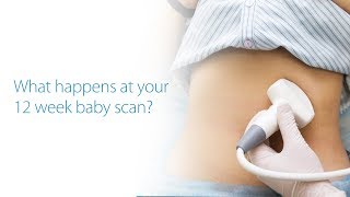 What to Expect At Your 12 Week Baby Scan Dublin Ireland [upl. by Eeryt]