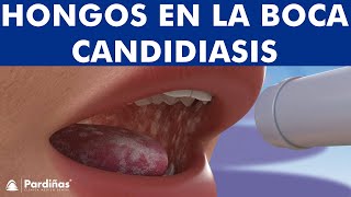 CANDIDIASIS oral y BOQUERAS  Cómo CURAR los hongos de la boca © [upl. by Moses]