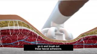 Cellulite FasciaBlaster Animation [upl. by Stoffel]