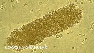 Análisis de Sedimentos en Orina UPRRCM Tecnología Médica 2016 [upl. by Aric]