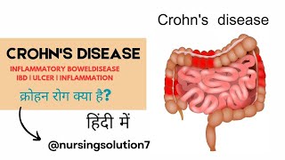 Crohns disease in hindi  Inflammatory bowel disease in hindi  Type  Cause  Symptoms  Treatment [upl. by Ecnerrat]