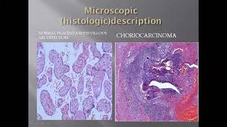 Histology of Choriocarcinoma [upl. by Girand769]