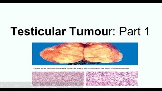 Seminoma Clinical picture Morphology and staging [upl. by Natrav]