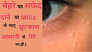 Milia  Milia क्यों होते है  Milia का ईलाज  Treatment of Milia in hindi  इसे बदने से कैसे रोके [upl. by Harlin935]