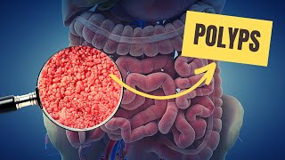 Defeat Polyps Naturally Home Remedies for a Happy Healthy Colon [upl. by Enimaj]