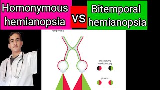 homonymous and bitemporal hemianopsia [upl. by Stephanie]