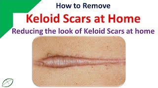 How to Remove Keloid Scars at Home  Reducing the look of Keloid Scars at home [upl. by Taka]