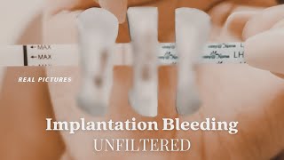 IMPLANTATION BLEEDING WITH PICTURES  Two Week Wait Bfp  Bfn Symptoms [upl. by Apollo945]