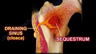 Pathology 825 f Pyogenic Osteomyelitis Pathogenesis Gross Involucrum Brodies abscess [upl. by Carole]