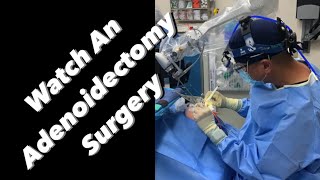 Adenoidectomy  actual footage [upl. by Deehan]