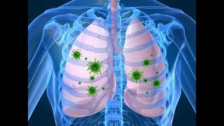 8 síntomas de la pulmonía que no puedes ignorar [upl. by Ellednek]