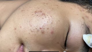 ACNE TREATMENT VU QUYNH MI Acne On Boys Chin 2024 [upl. by Pincus717]