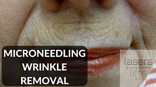 Microneedling for skin rejuvenation [upl. by Eimiaj]