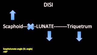 DISI and VISI abnormalities of the Wrist [upl. by Grosberg]