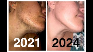 Results after 161 Hours of Electrolysis hair removal PCOS Hirsutism excess facial hair support [upl. by Etteb]