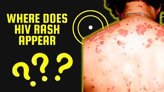 Where does HIV Rash Appear   Skin Conditions Associated with HIV [upl. by Medin130]