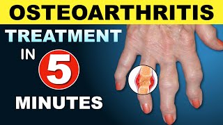 Osteoarthritis Treatment  New Medicines amp Updates [upl. by Ahtnammas294]