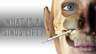 What is a sinus lift [upl. by Kenay]