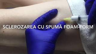 Scleroterapia cu spumă foamform a vaselor membrelor inferioare [upl. by Esirahs]