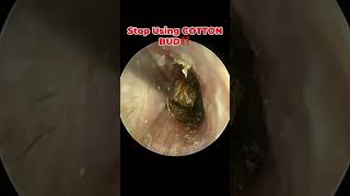 Deep Impacted Cerumen With Severely Swollen Ear Canal [upl. by Tomkiel]