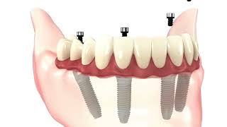 All on 4 dental implants [upl. by Robert596]