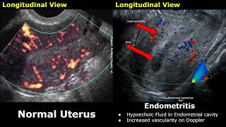 Uterus amp Adnexa Ultrasound Normal Vs Pelvic Inflammatory Disease PID Images  Gynecological USG [upl. by Yousuf29]